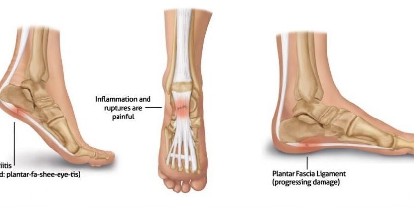 Plantar Fasciitis