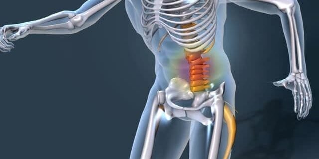 sciatica photo